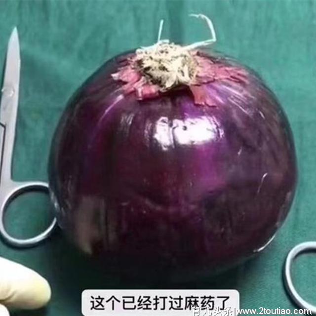 剖腹产就是“睡一觉”那么轻松？看这颗洋葱，才知道为母则刚