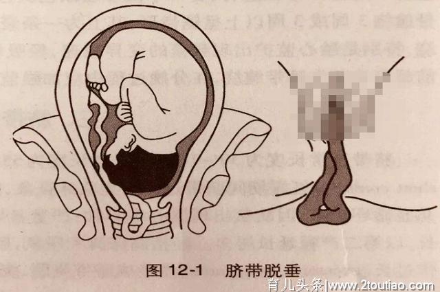 为什么明明能顺产，有时医生还是劝孕妇剖宫产？真实理由令人唏嘘