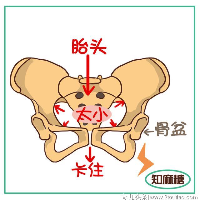 剖腹产，你必须要知道的事