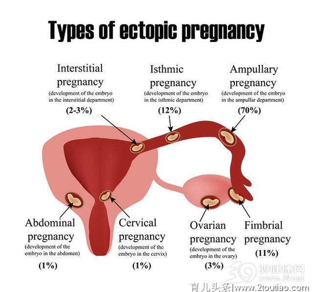 你是不是宫外孕？5个症状告诉你！