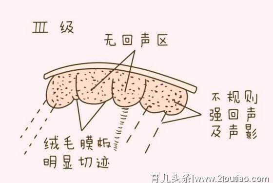 胎盘成熟度几级能发动？分娩何时发动，由这几个因素决定