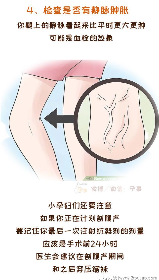 预防孕期危险的静脉血栓，这11个方法学起来