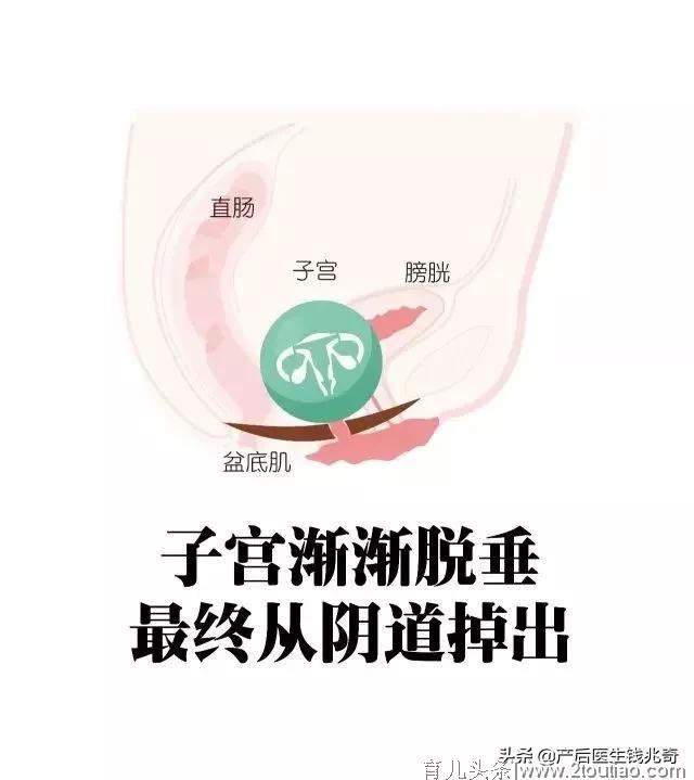 产后康复，你真了解吗？